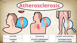 Atherosclerosis : स्ट्रोक, दिल का दौरा और अचानक मृत्यु का कारण