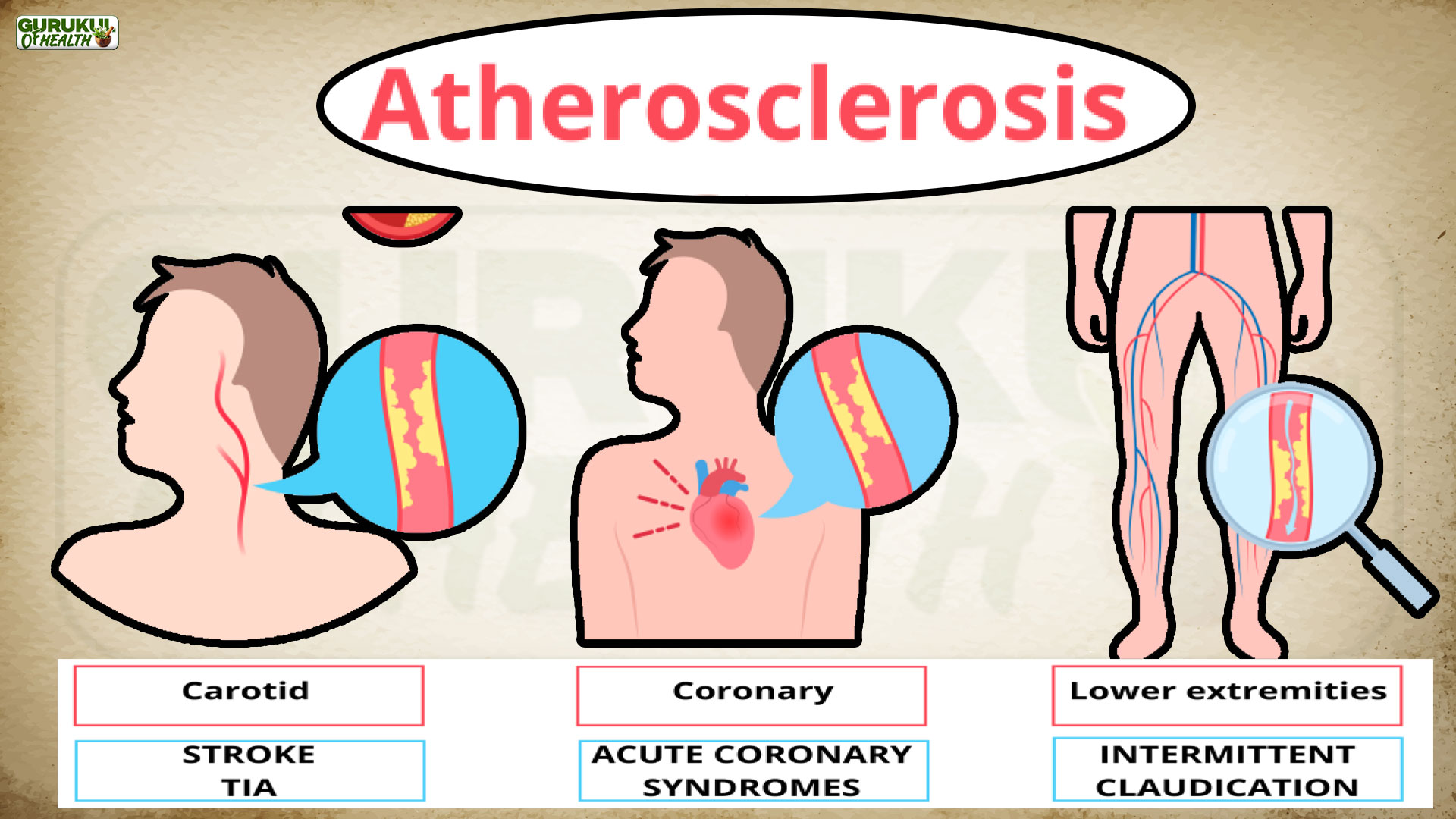 Atherosclerosis
