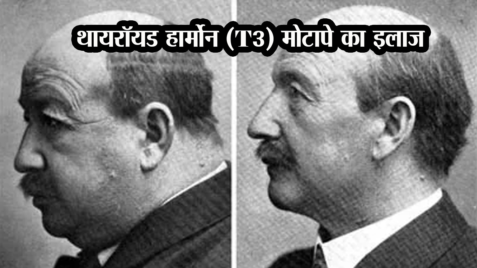 थायरॉयड हार्मोन (T3): मोटापे का इलाज?