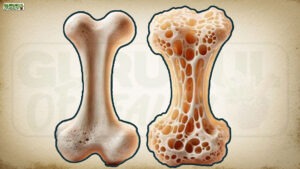 ऑस्टियोपोरोसिस: हड्डियों का खामोश दुश्मन Osteoporosis